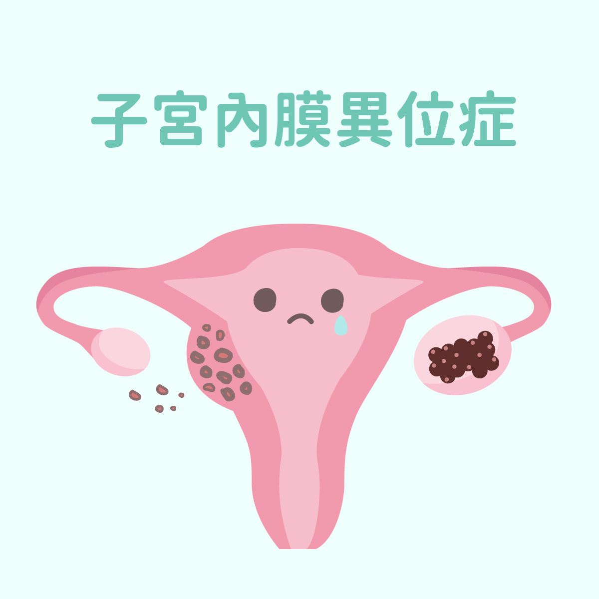 子宮內膜異位症的治療與診斷