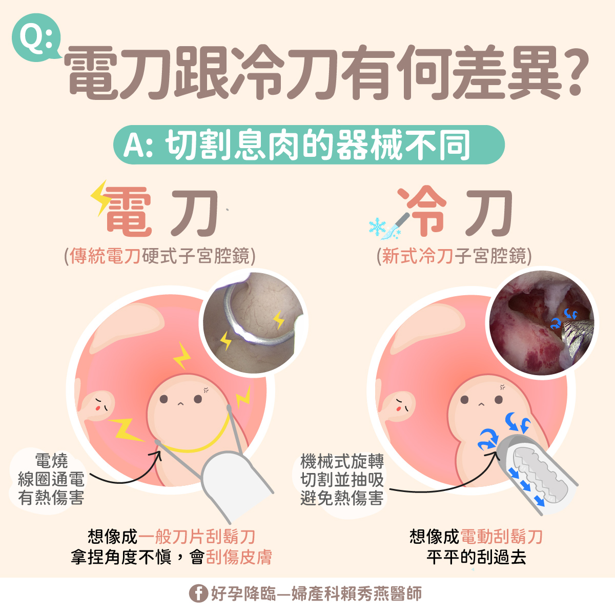 子宮腔鏡又有分電刀跟冷刀？