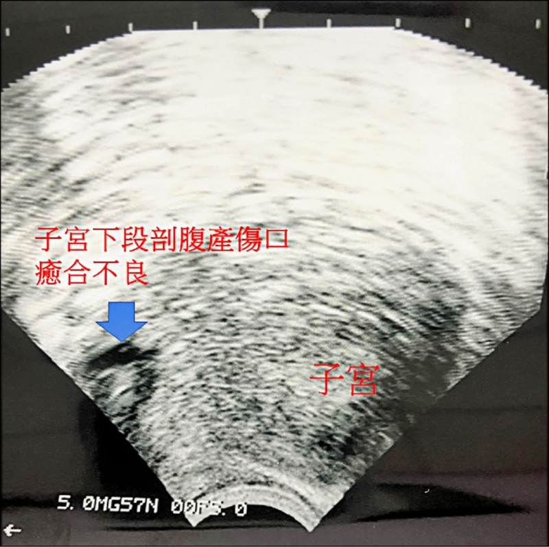 剖腹傷口癒合不良 產後月經滴滴答答